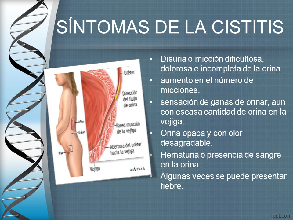Cistitis con sangre en orina